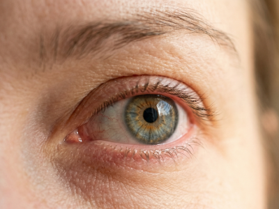 Severe Dry Eye Scleral Lens Treatment Round Rock TX